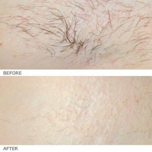 laser ipl melbourne