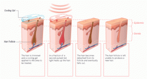 hair removal melbourne